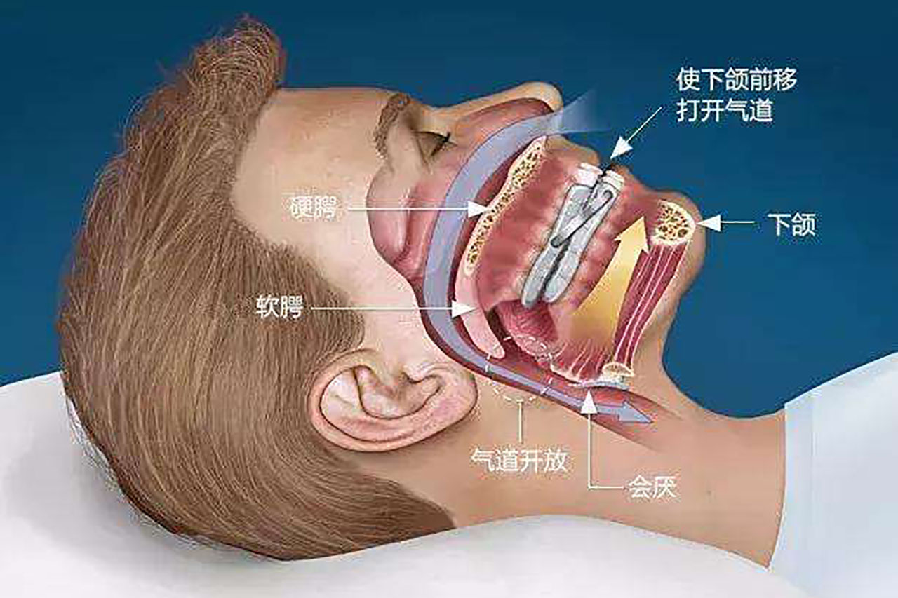 睡觉打鼾不要不当回事!这是病!