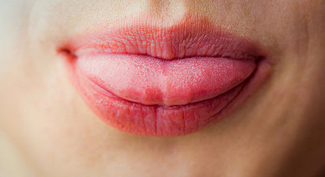 从舌头看五种上火症状