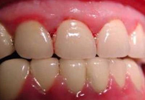 牙龈炎的早期出现这七大症状要注意!